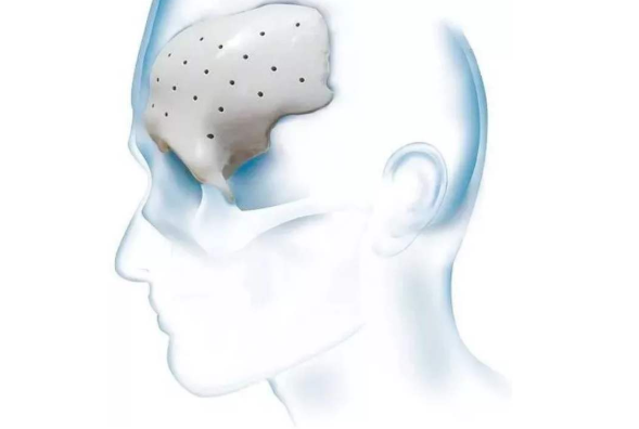 等離子清洗機(jī)會(huì)對(duì)PEEK材料起到怎樣的作用？-普樂(lè)斯